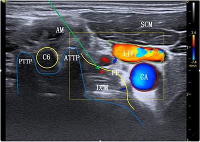 Effects of Stellate Ganglion Block Through Different Approaches Under Guidance of Ultrasound